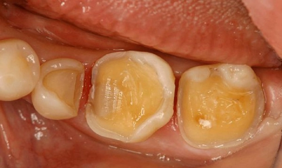 Miếng trám bị hao mòn, sứt mẻ dưới tác động của lực nhai